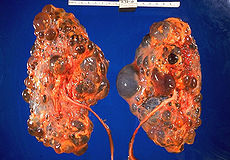 Polycystic_kidneys