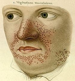 TuberousSclerosis-Rayer-ColourSmall