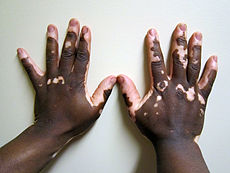 Vitiligo2